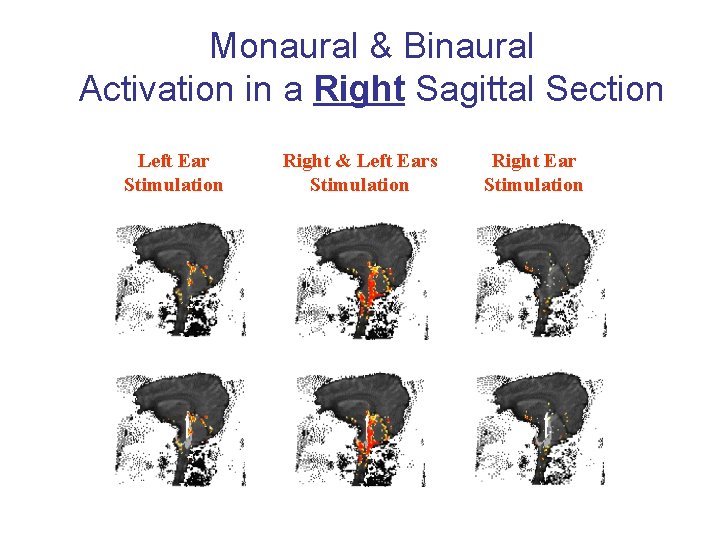 Monaural & Binaural Activation in a Right Sagittal Section Left Ear Stimulation Right &