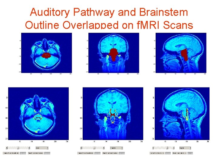 Auditory Pathway and Brainstem Outline Overlapped on f. MRI Scans 