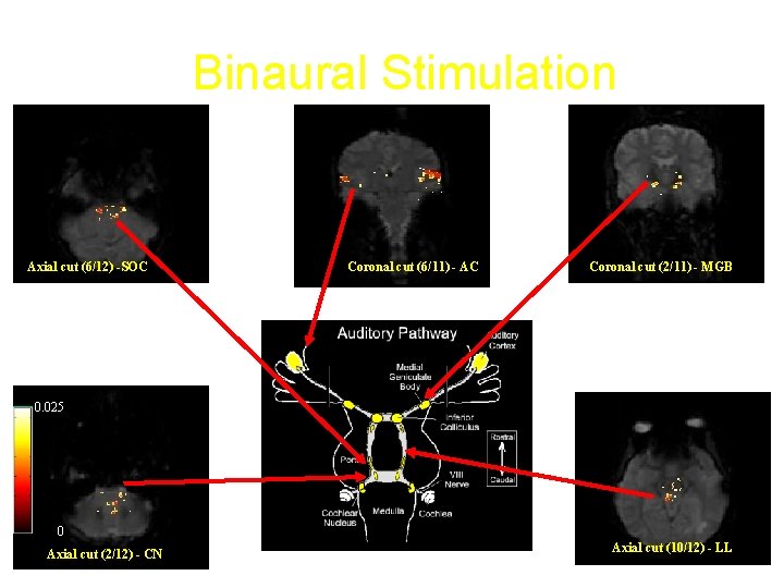 Binaural Stimulation Axial cut (6/12) -SOC Coronal cut (6/11) - AC Coronal cut (2/11)