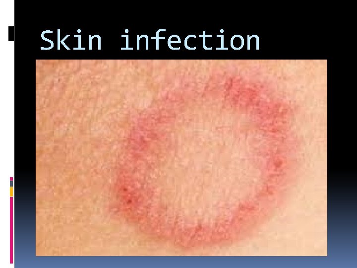 Skin infection 