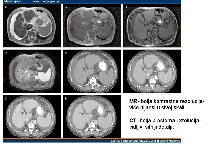MR- bolja kontrastna rezolucijaviše nijansi u sivoj skali. CT -bolja prostorna rezolucijavidljivi sitniji detalji.