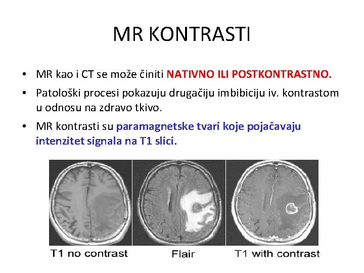 MR KONTRASTI • MR kao i CT se može činiti NATIVNO ILI POSTKONTRASTNO. •