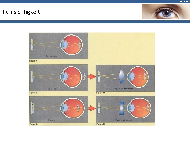 05 / Sehen Fehlsichtigkeit 