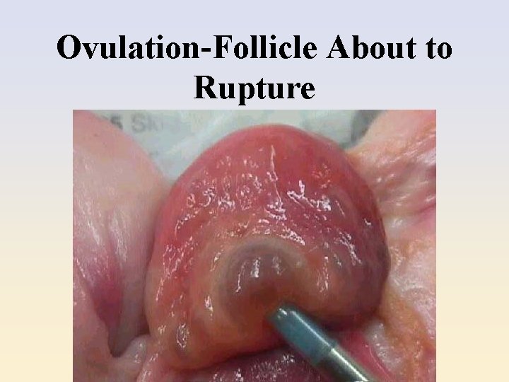 Ovulation-Follicle About to Rupture 