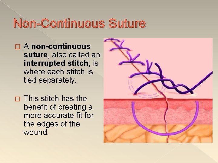 Non-Continuous Suture � A non-continuous suture, also called an interrupted stitch, is where each
