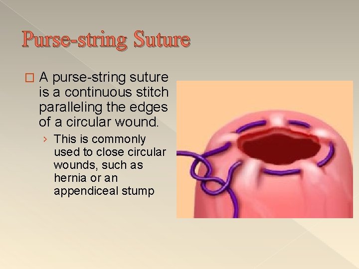Purse-string Suture � A purse-string suture is a continuous stitch paralleling the edges of