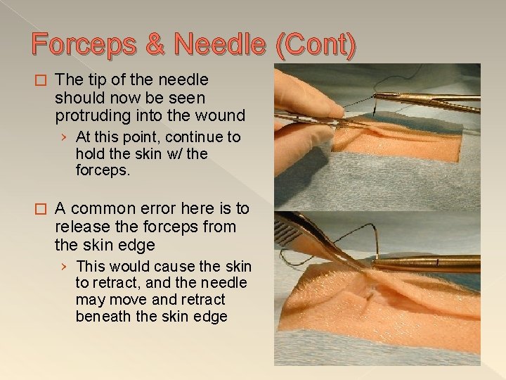 Forceps & Needle (Cont) � The tip of the needle should now be seen