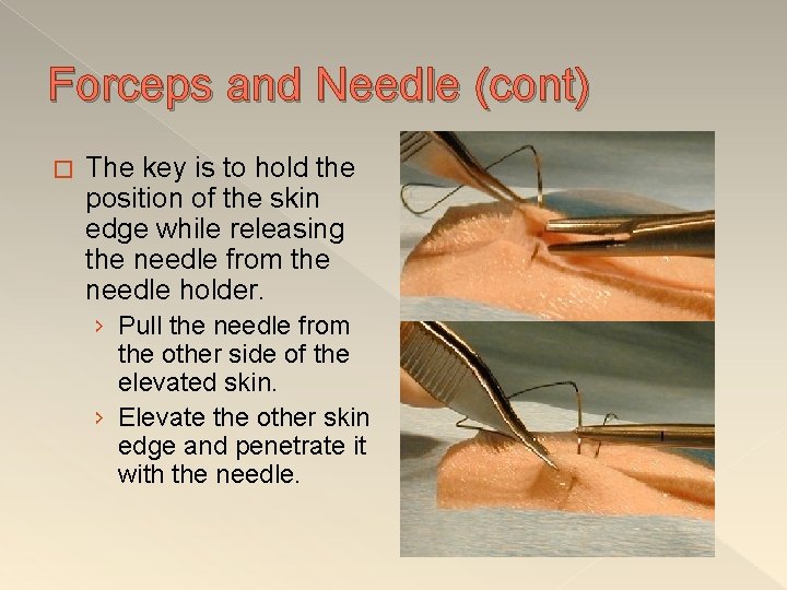 Forceps and Needle (cont) � The key is to hold the position of the