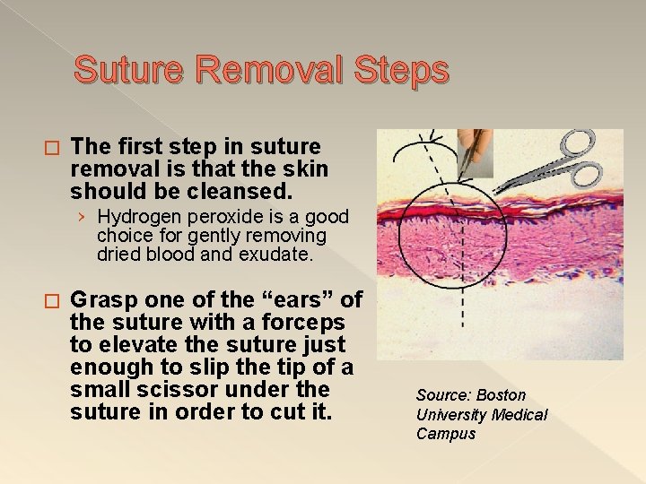 Suture Removal Steps � The first step in suture removal is that the skin