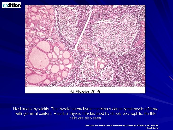 Hashimoto thyroiditis. The thyroid parenchyma contains a dense lymphocytic infiltrate with germinal centers. Residual