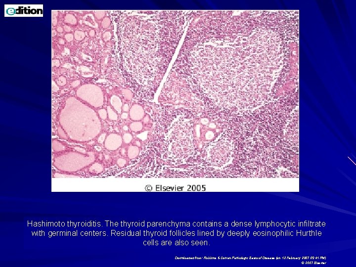 Hashimoto thyroiditis. The thyroid parenchyma contains a dense lymphocytic infiltrate with germinal centers. Residual Hashimoto thyroiditis. The thyroid parenchyma contains a dense lymphocytic infiltrate with germinal centers. Residual