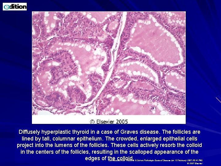 Diffusely hyperplastic thyroid in a case of Graves disease. The follicles are lined by Diffusely hyperplastic thyroid in a case of Graves disease. The follicles are lined by