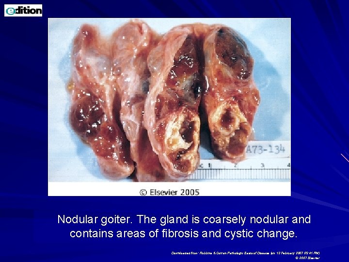 Nodular goiter. The gland is coarsely nodular and contains areas of fibrosis and cystic