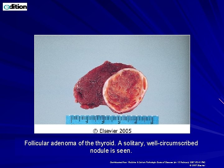 Follicular adenoma of the thyroid. A solitary, well-circumscribed nodule is seen. Downloaded from: Robbins Follicular adenoma of the thyroid. A solitary, well-circumscribed nodule is seen. Downloaded from: Robbins