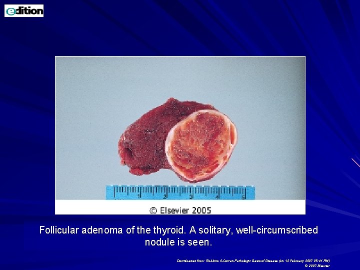 Follicular adenoma of the thyroid. A solitary, well-circumscribed nodule is seen. Downloaded from: Robbins