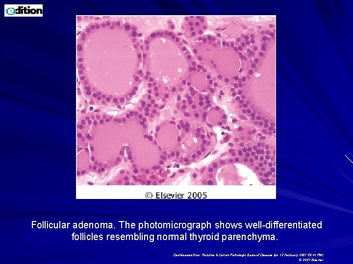 Follicular adenoma. The photomicrograph shows well-differentiated follicles resembling normal thyroid parenchyma. Downloaded from: Robbins