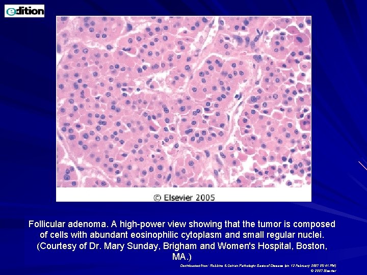 Follicular adenoma. A high-power view showing that the tumor is composed of cells with Follicular adenoma. A high-power view showing that the tumor is composed of cells with