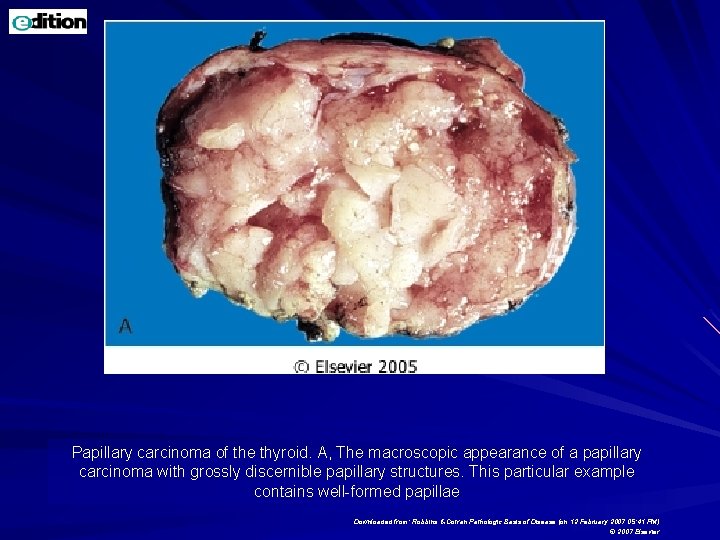 Papillary carcinoma of the thyroid. A, The macroscopic appearance of a papillary carcinoma with