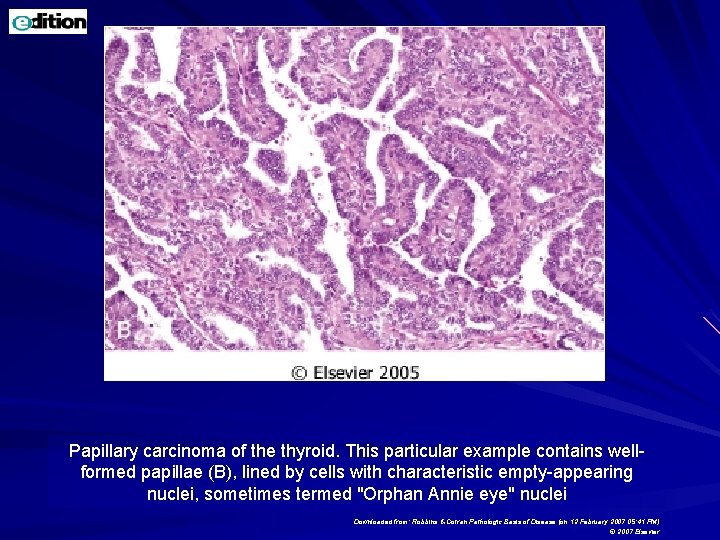 Papillary carcinoma of the thyroid. This particular example contains wellformed papillae (B), lined by Papillary carcinoma of the thyroid. This particular example contains wellformed papillae (B), lined by