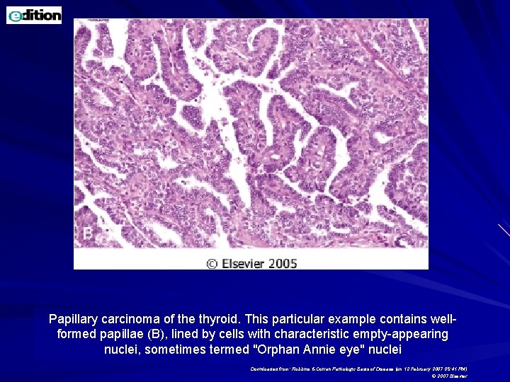 Papillary carcinoma of the thyroid. This particular example contains wellformed papillae (B), lined by