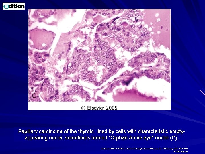 Papillary carcinoma of the thyroid. lined by cells with characteristic emptyappearing nuclei, sometimes termed Papillary carcinoma of the thyroid. lined by cells with characteristic emptyappearing nuclei, sometimes termed