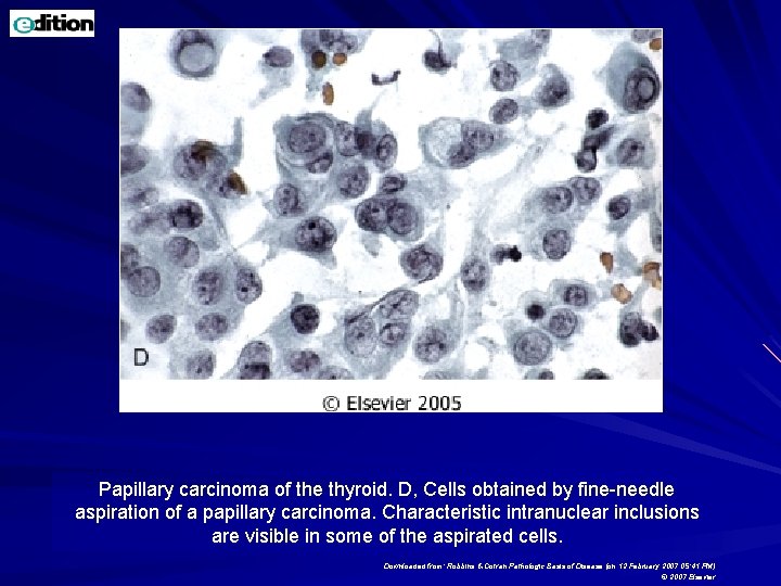 Papillary carcinoma of the thyroid. D, Cells obtained by fine-needle aspiration of a papillary Papillary carcinoma of the thyroid. D, Cells obtained by fine-needle aspiration of a papillary