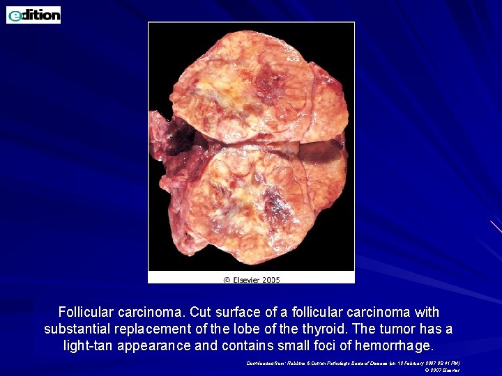 Follicular carcinoma. Cut surface of a follicular carcinoma with substantial replacement of the lobe Follicular carcinoma. Cut surface of a follicular carcinoma with substantial replacement of the lobe