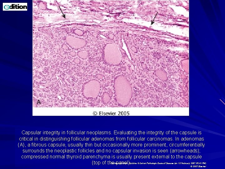 Capsular integrity in follicular neoplasms. Evaluating the integrity of the capsule is critical in