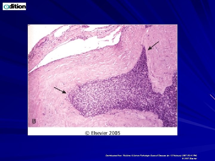 Downloaded from: Robbins & Cotran Pathologic Basis of Disease (on 12 February 2007 05: Downloaded from: Robbins & Cotran Pathologic Basis of Disease (on 12 February 2007 05: