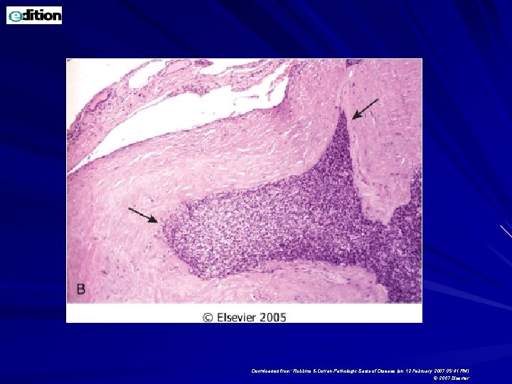 Downloaded from: Robbins & Cotran Pathologic Basis of Disease (on 12 February 2007 05: