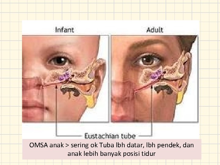 OMSA anak > sering ok Tuba lbh datar, lbh pendek, dan anak lebih banyak