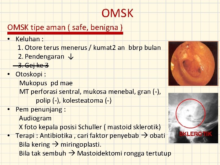 OMSK tipe aman ( safe, benigna ) • Keluhan : 1. Otore terus menerus