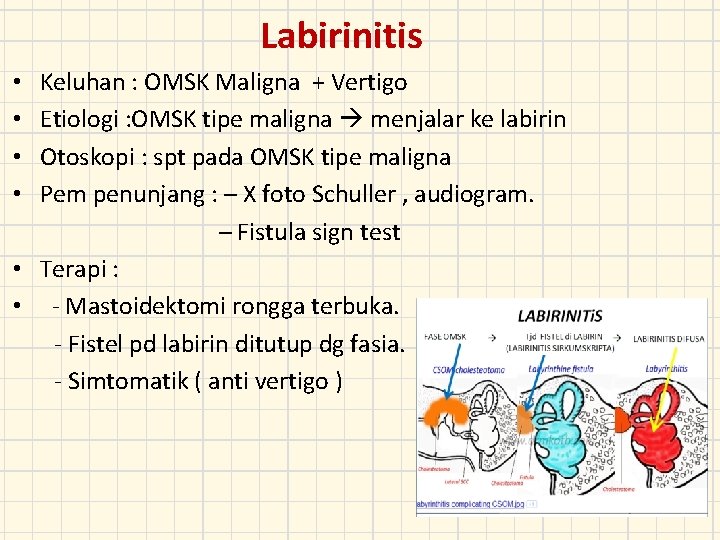 Labirinitis Keluhan : OMSK Maligna + Vertigo Etiologi : OMSK tipe maligna menjalar ke