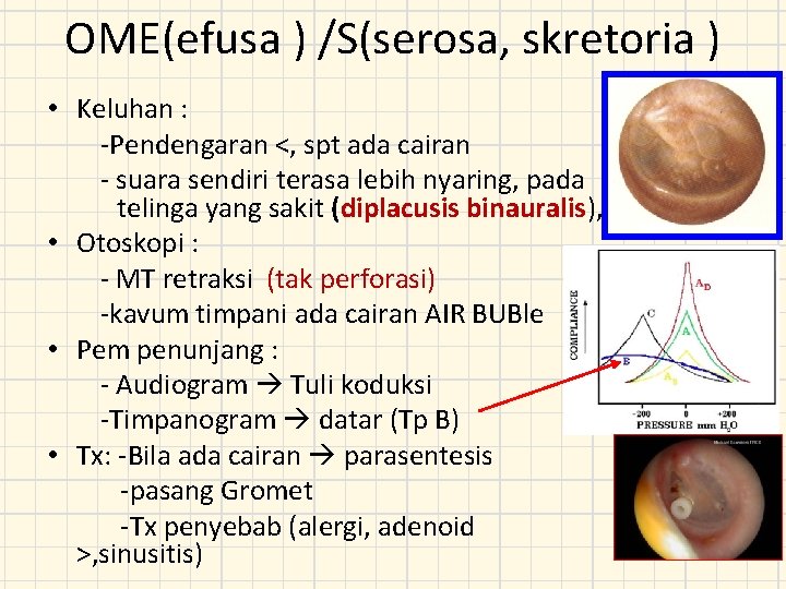 OME(efusa ) /S(serosa, skretoria ) • Keluhan : -Pendengaran <, spt ada cairan -