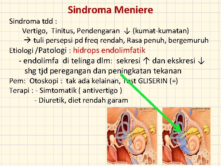 Sindroma Meniere Sindroma tdd : Vertigo, Tinitus, Pendengaran ↓ (kumat-kumatan) tuli persepsi pd freq