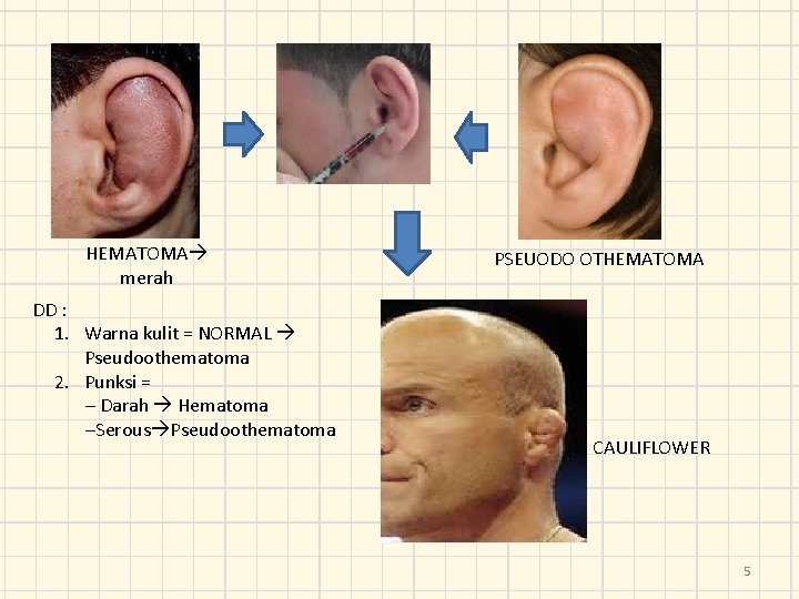 HEMATOMA merah DD : 1. Warna kulit = NORMAL Pseudoothematoma 2. Punksi = –