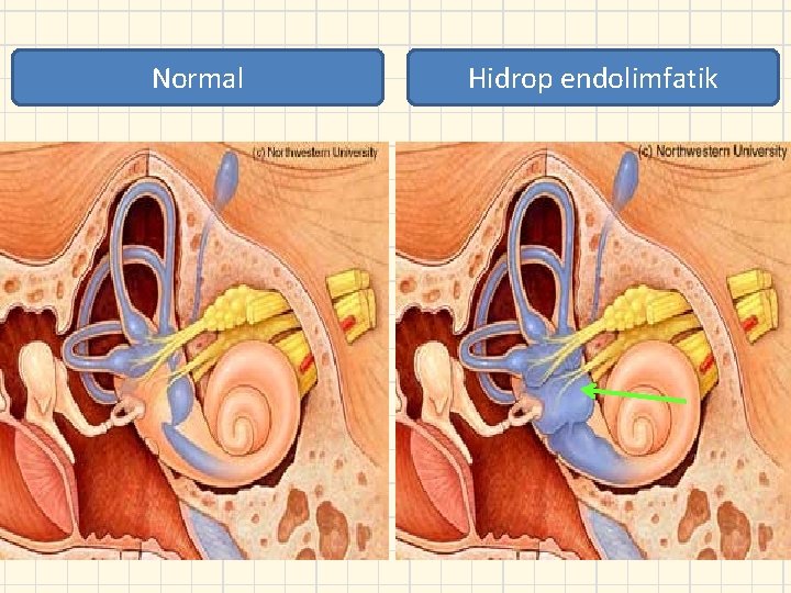 Normal Hidrop endolimfatik 