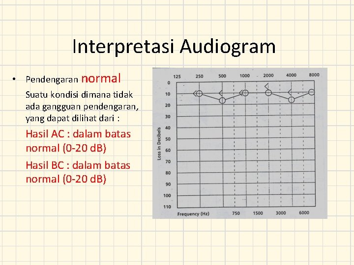 Interpretasi Audiogram • Pendengaran normal Suatu kondisi dimana tidak ada gangguan pendengaran, yang dapat