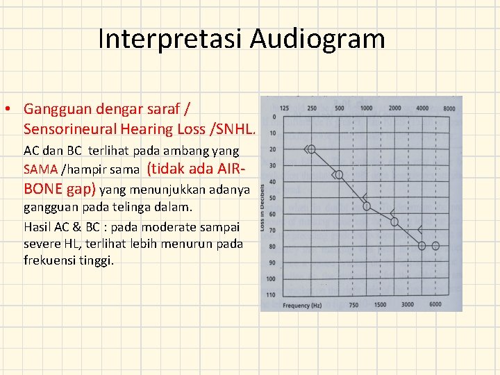 Interpretasi Audiogram • Gangguan dengar saraf / Sensorineural Hearing Loss /SNHL. AC dan BC