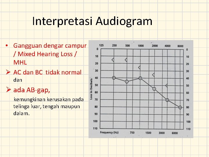 Interpretasi Audiogram • Gangguan dengar campur / Mixed Hearing Loss / MHL Ø AC