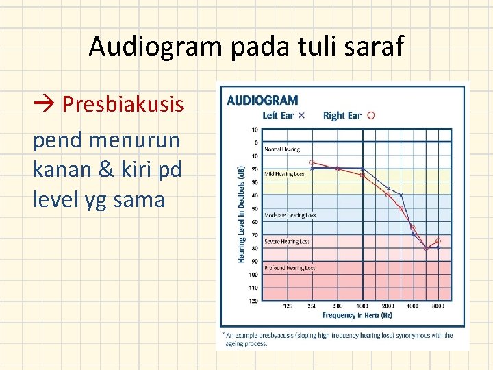 Audiogram pada tuli saraf Presbiakusis pend menurun kanan & kiri pd level yg sama