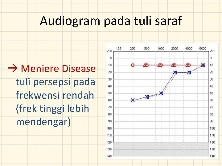 Audiogram pada tuli saraf Meniere Disease tuli persepsi pada frekwensi rendah (frek tinggi lebih
