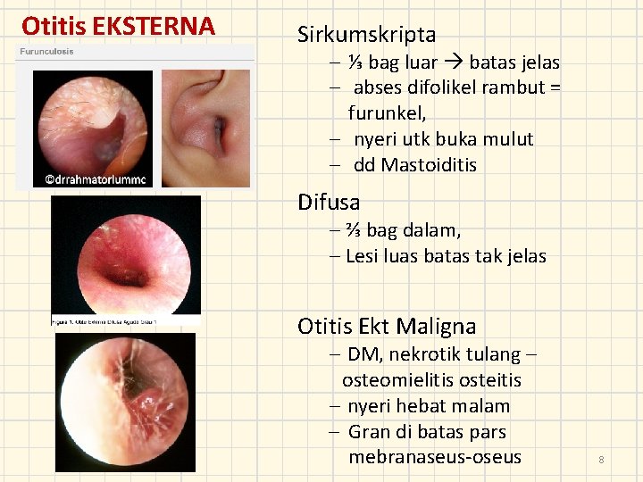 Otitis EKSTERNA Sirkumskripta – ⅓ bag luar batas jelas – abses difolikel rambut =