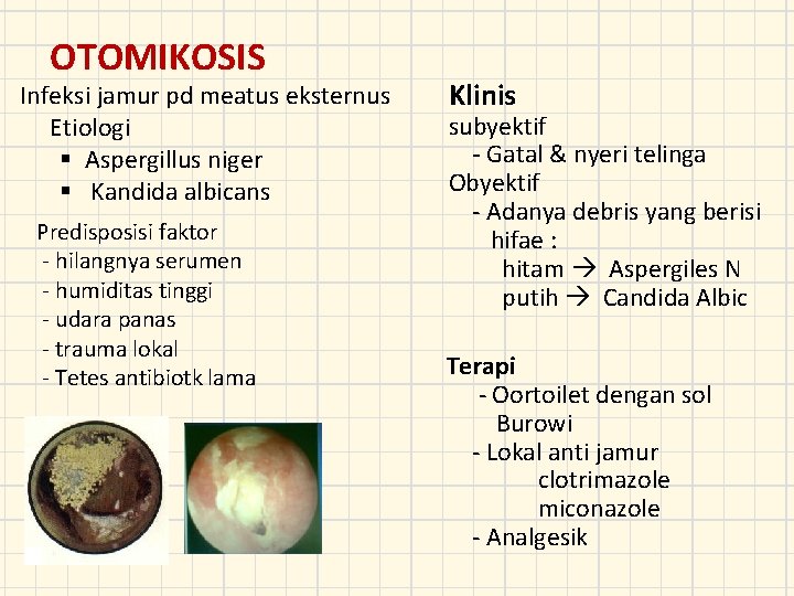 OTOMIKOSIS Infeksi jamur pd meatus eksternus Etiologi § Aspergillus niger § Kandida albicans Predisposisi