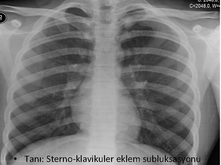  • Tanı: Sterno-klavikuler eklem subluksasyonu 