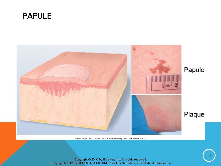 PAPULE 11 Copyright © 2016 by Elsevier, Inc. All rights reserved. Copyright © 2012,