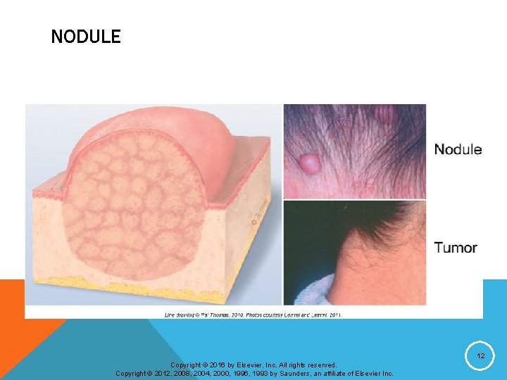 NODULE 12 Copyright © 2016 by Elsevier, Inc. All rights reserved. Copyright © 2012,