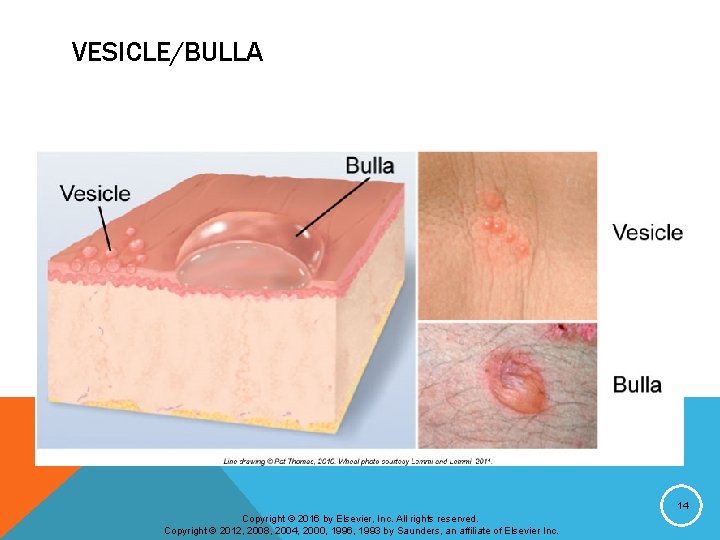 VESICLE/BULLA 14 Copyright © 2016 by Elsevier, Inc. All rights reserved. Copyright © 2012,
