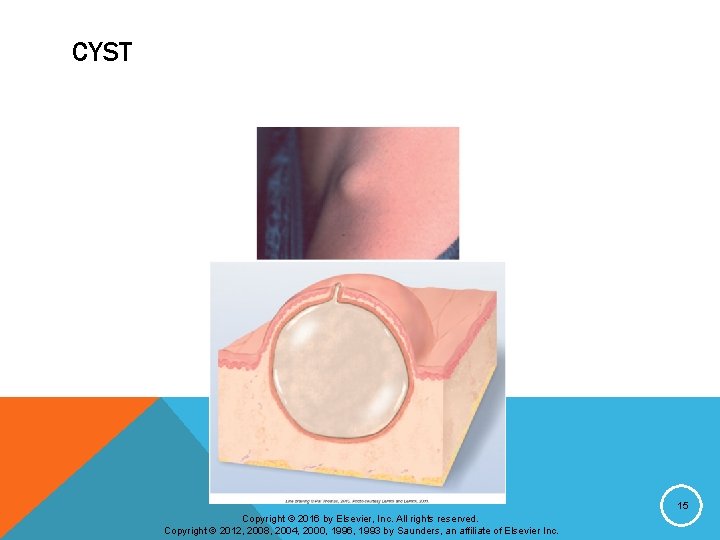CYST 15 Copyright © 2016 by Elsevier, Inc. All rights reserved. Copyright © 2012,