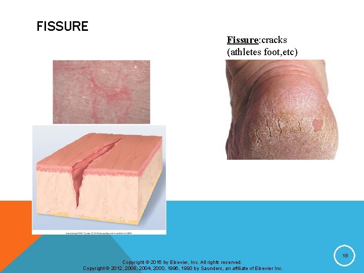 FISSURE Fissure: cracks (athletes foot, etc) 18 Copyright © 2016 by Elsevier, Inc. All